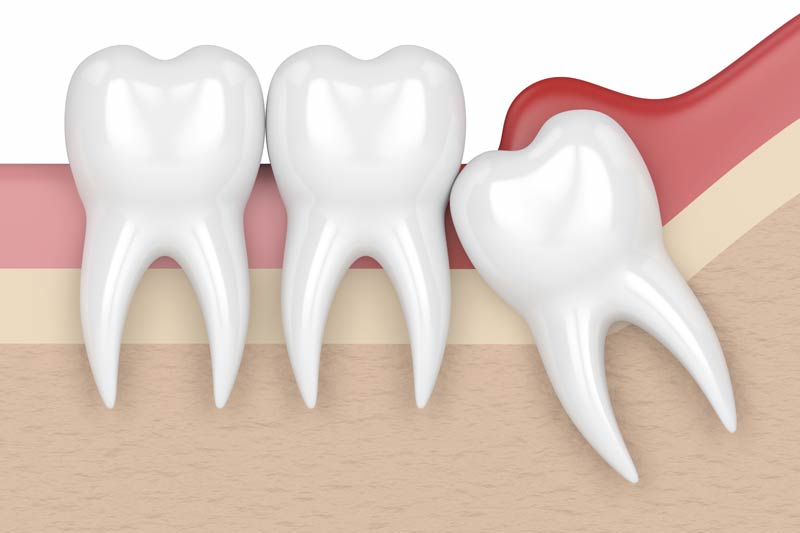 Sinus Augmentation in Katy